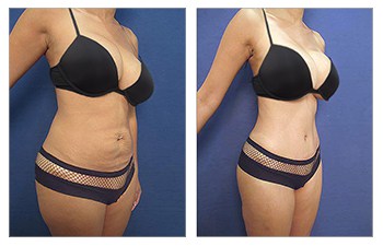 HD VASER lipo of lower abdomen, flanks, lower abck, fat grafting to buttocks and breasts, TT, BA revision