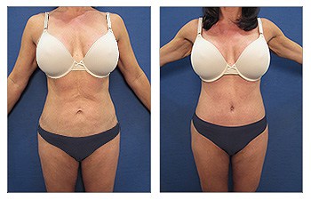 How much weight can you use lose after liposuction Case Study 3