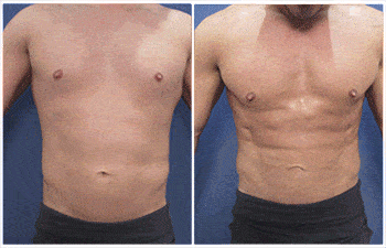 High Definition Abdominal Etching with VASER liposuction