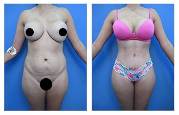 High Definition Liposuction Body Scale dictated performing VASER liposuction in combination with Modified abdominal skin resection