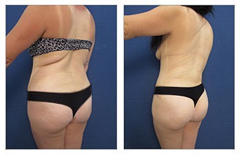 Power assisted liposuction of back routinely used to optimize fat removal