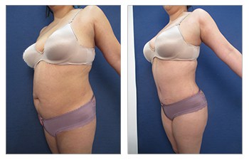 How much weight can you lose with liposuction Case Study