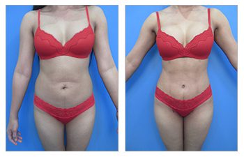 High definition Tummy tuck and VASER Liposuction