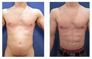 High definition liposuction chest sculpting