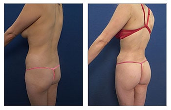 High definition liposuction with VASER and Renuvion skin tightening of the abdomen, back, flanks, arms, axilla, abdomen, and fat grafting to the buttocks for the Ideal Buttocks Shape.