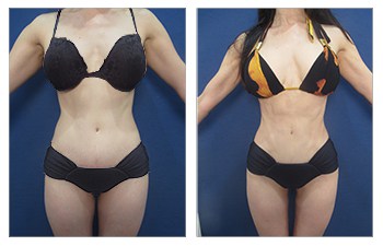High defintion Body Contouring with VASER liposuction and Renuvion skin tightening of her flanks, back, medial thighs, arms, and fat grafting to buttocks.