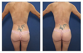 Ideal Buttocks Shape with High Definition VASER Liposuction of the abdomen, back , flanks, and Brazilian Butt LIft.