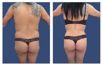 Ideal Buttocks Shape with high definition VASER lipo of flanks, lower back, BBL, and tummy tuck.