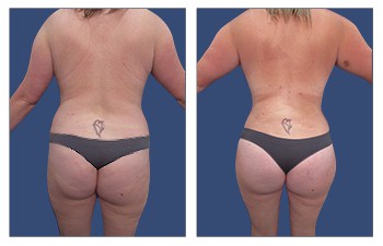 Ideal Buttocks Shape with high-definition VASER liposuction of flanks, lower back, lateral thighs, BBL, abdominoplasty with muscle plication, and breast lift.