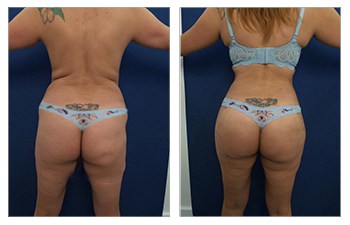 Ideal buttocks shape, Extended tummy tuck, VASER Lipo and Renuvion of back and waistline.