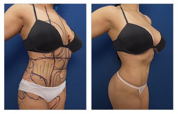 Ideal buttocks shape, High Definition VASER Lipo, Renuvion skin tightening of the abdomen, back, medial and lateral thighs, and BBL, Breast lift with augmentation