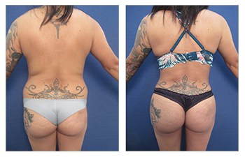 Ideal buttocks shape, High definition liposuction and Renuvion skin tightenign of the flanks, back, medial thighs, BBL, and abdominoplasty revision.