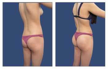 Ideal buttocks shape high definition liposuction of flanks, Brazilian Butt Lift (BBL), and buttock implant.