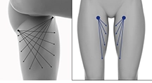 Inner Thigh treatment with radiofrequency skin tightening procedure.