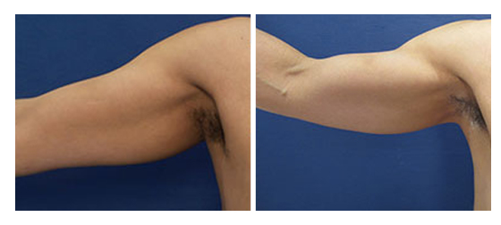 Liposuction arms before and after.