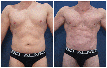 Male Ab Etching with High Definition Liposuction and Mini Tummy Tuck