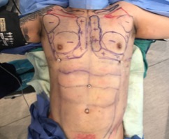 Male High Definition Liposuction Preoperative Markings for chest sculpting