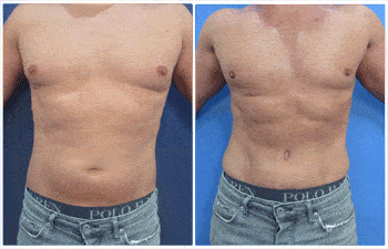 Male abdominal etching with VASER Liposuction and Renuvion J Plasma