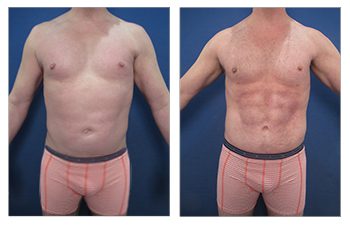 Male abdominal etching wtih symmetric six-pack abs