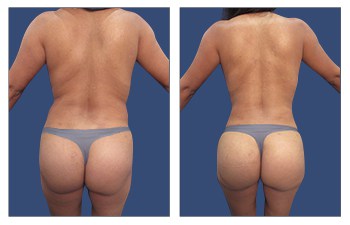 VASER Liposuction and fat transfer to achieve excellent BBL results
