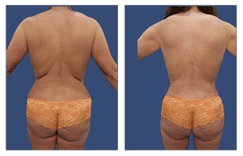 Mini abdominoplasty, high definition liposuction of the flanks, abdomen, medial thighs, and arms, fat grafting to the buttocks.