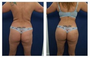 Power-Assisted Liposuction (PAL) used in back contouring