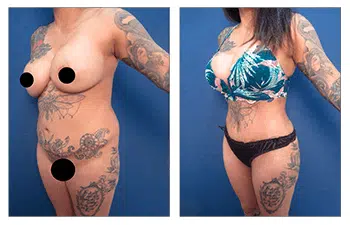 Renuvion before and after benefits HD Liposuction outcomes