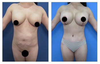 Case Study demonstrating how revision Liposuction Works