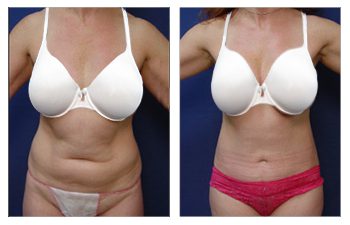 How Does Liposution Work Case Study