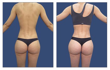 Revision Body Contouring Complications with High definition liposuction of the abdomen, flanks, lower back, middle back, upper back, medial thighs, lateral thighs, calves, axilla, Renuvion of medial thighs and, BBL redo