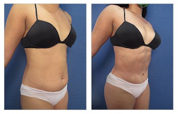 Rour-Pack abs after VASER liposuction of the abdomen, and high definition tummy tuck