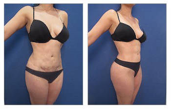 Scarless skin tightening with HD VASER lipo of abdomen, medial thighs, lateral breasts, knees, back, lateral thighs, pubic mons, fat grafting to medial and upper breasts and buttock, renuvion of medial thighs, lateral thighs, lower,middle,upper back, abdomen.