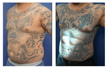 Six-Pack Abs following Ultasound Assisted Liposuction and Renuvion J plasma skin tightening of the abdomen.