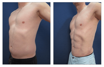 Six-Pack abs with VASER liposcution and high defintion tummy tuck.