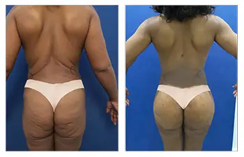 Thigh reduction and tightening following a buttock and thigh lift.