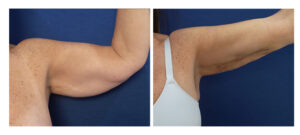 Underarm Liposuctiion with VASER and Renuvion skin tightening