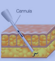 An image of a canula removing deep fat resulting in skin retraction