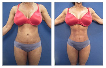 VASER Liposuction before and after using High Definition Liposuction protocols