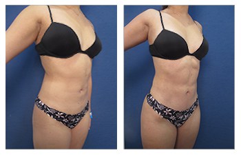VASER liposuciotn of the flanks, lower back, middle back, upper back, flanks, arms and abdomen, fat grafting to the buttocks, mini abdominoplasty and Renuvion of middle back,