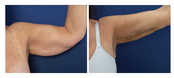 A woman's arm before and after liposuction and Renuuvion skin tightening