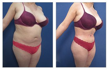 How Does Liposuction work?