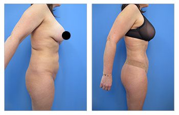 It is very important not to gain weight after liposuction or you risk returing to your preoperative figure.
