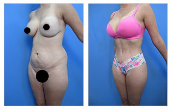 Multiple procedures including modified abdoinal skin reection, lateral thigh tuck, and VASER liposuction and BBL