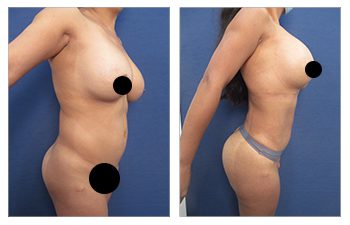 How much does liposuction cost dependent on your surgeon's experience