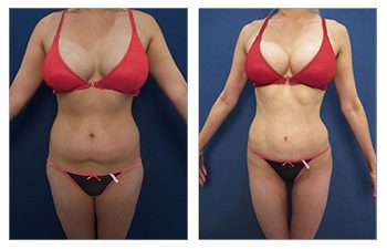 How much does liposuction cost determined by operative time
