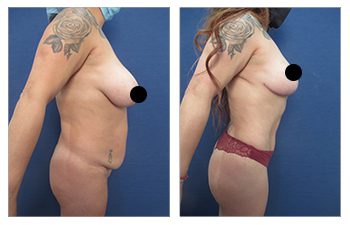 How Long is Liposuction Recovery