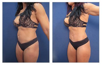 How much does liposuction cost is based on the scope of surgery