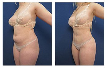 Body Contouring Case demonhstrating how long is liposuction recovery