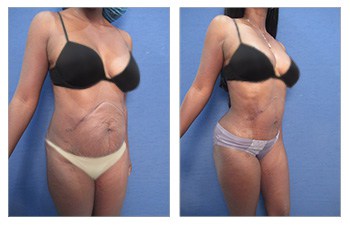 Waistline Narrowing with HD VASER lipo of abdomen, flanks, lower back, upper back, scar revision of abdomen, abdominal flap advancement, mini tummy tuck, fat grafting to buttock and breasts