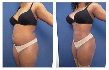 Waistline Narrowing with HD VASER lipo of abdomen, flanks, lower,middle,upper back, and fat grafting to the buttocks.